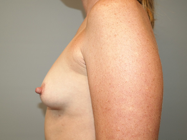 Breast Augmentation Before and After 36 | Grover Aesthetics