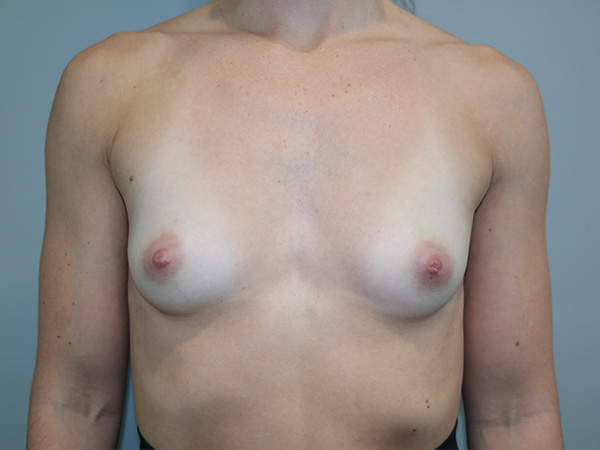Breast Augmentation Before and After | Grover Aesthetics