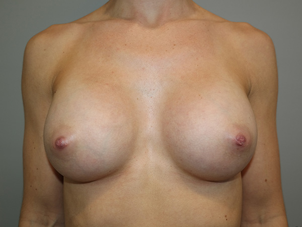 Breast Augmentation Before and After | Grover Aesthetics