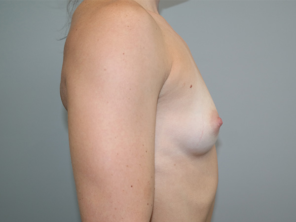 Breast Augmentation Before and After 38 | Grover Aesthetics