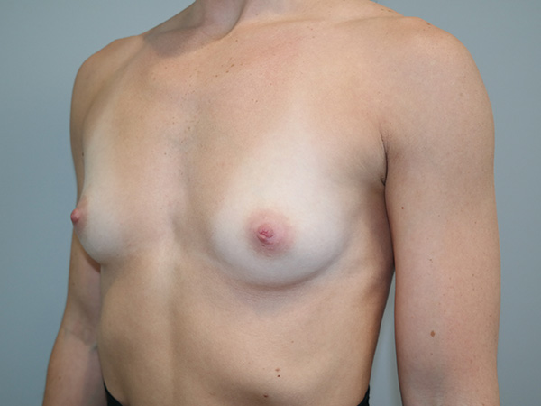 Breast Augmentation Before and After 38 | Grover Aesthetics