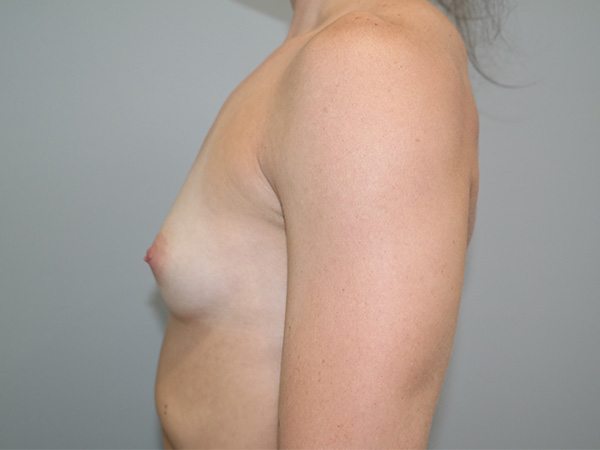Breast Augmentation Before and After 38 | Grover Aesthetics