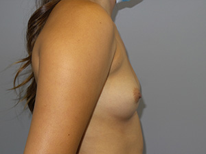 Breast Augmentation Before and After 41 | Sanjay Grover MD FACS