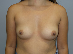 Breast Augmentation Before and After 313 | Sanjay Grover MD FACS