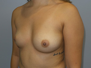 Breast Augmentation Before and After 42 | Grover Aesthetics