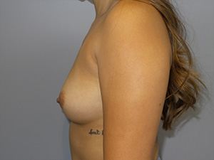 Breast Augmentation Before and After 42 | Grover Aesthetics