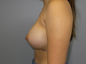 Breast Augmentation Before and After 42 | Grover Aesthetics