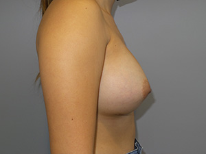 Breast Augmentation Before and After 42 | Grover Aesthetics