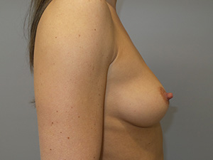 Breast Augmentation Before and After 43 | Grover Aesthetics