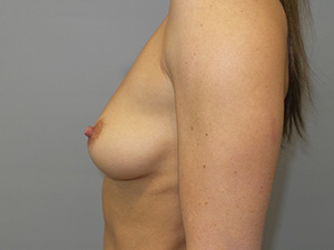 Breast Augmentation Before and After 43 | Grover Aesthetics