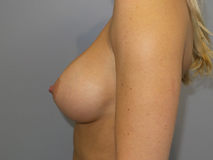 Breast Augmentation Before and After 43 | Grover Aesthetics
