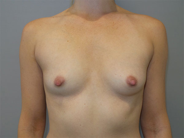 Breast Augmentation Before and After | Grover Aesthetics