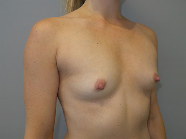 Breast Augmentation Before and After 44 | Grover Aesthetics
