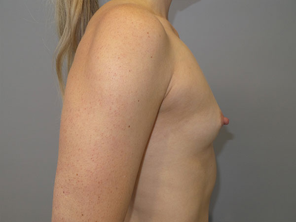 Breast Augmentation Before and After 44 | Grover Aesthetics