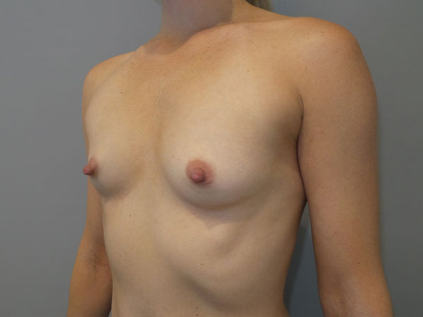Breast Augmentation Before and After 44 | Grover Aesthetics