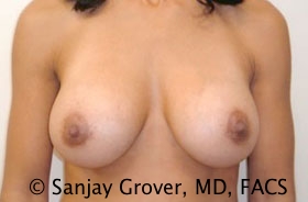 Breast Augmentation Before and After 47 | Sanjay Grover MD FACS