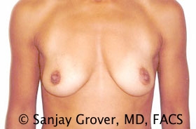 Breast Augmentation Before and After 283 | Sanjay Grover MD FACS