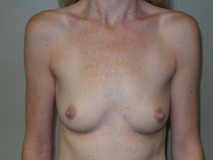 Breast Augmentation Before and After | Grover Aesthetics