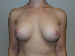 Breast Augmentation Before and After 50 | Sanjay Grover MD FACS