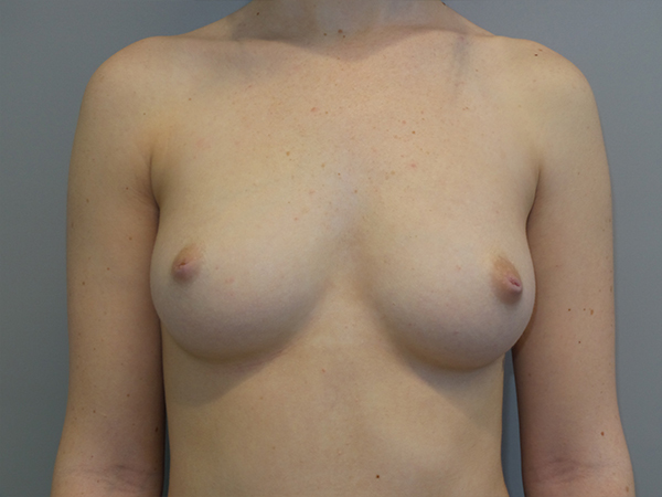 Breast Augmentation Before and After | Grover Aesthetics