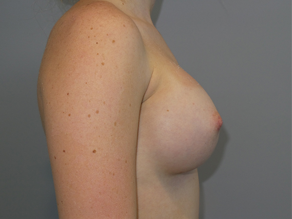 Breast Augmentation Before and After 51 | Grover Aesthetics