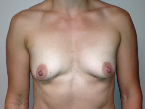 Breast Augmentation Before and After 29 | Sanjay Grover MD FACS