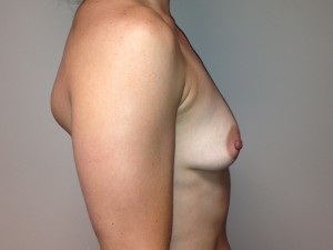 Breast Augmentation Before and After 52 | Sanjay Grover MD FACS