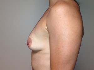 Breast Augmentation Before and After 52 | Grover Aesthetics