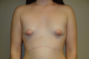 Breast Augmentation Before and After | Grover Aesthetics