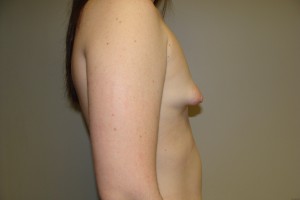 Breast Augmentation Before and After 53 | Grover Aesthetics