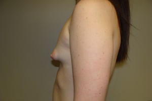 Breast Augmentation Before and After 53 | Grover Aesthetics