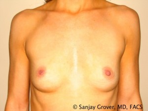 Breast Augmentation Before and After | Sanjay Grover MD FACS