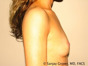 Breast Augmentation Before and After 54 | Sanjay Grover MD FACS