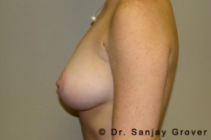 Breast Augmentation Before and After 57 | Sanjay Grover MD FACS