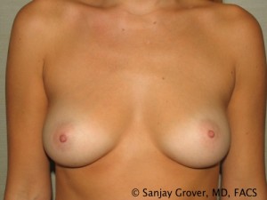 Breast Augmentation Before and After | Grover Aesthetics