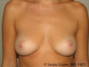 Breast Augmentation Before and After | Sanjay Grover MD FACS