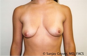 Breast Augmentation Before and After 198 | Sanjay Grover MD FACS