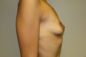 Breast Augmentation Before and After 60 | Sanjay Grover MD FACS