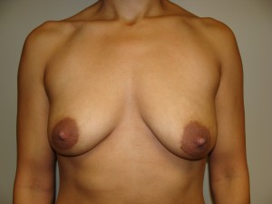 Breast Augmentation Before and After | Grover Aesthetics