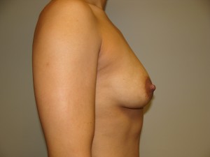 Breast Augmentation Before and After 61 | Grover Aesthetics