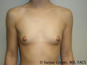 Breast Augmentation Before and After 63 | Sanjay Grover MD FACS