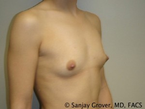 Breast Augmentation Before and After 62 | Grover Aesthetics