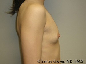 Breast Augmentation Before and After 62 | Grover Aesthetics