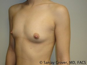 Breast Augmentation Before and After 62 | Grover Aesthetics