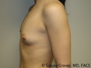 Breast Augmentation Before and After 62 | Grover Aesthetics