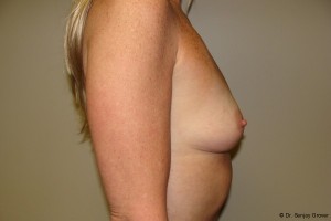Breast Augmentation Before and After 63 | Grover Aesthetics