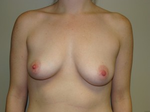 Breast Augmentation Before and After | Grover Aesthetics