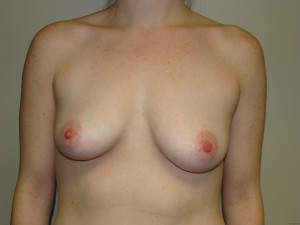 Breast Augmentation Before and After 163 | Sanjay Grover MD FACS