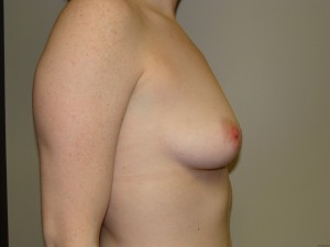 Breast Augmentation Before and After 66 | Grover Aesthetics