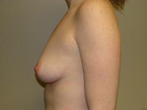 Breast Augmentation Before and After 66 | Grover Aesthetics